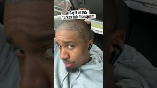 Day 8 After Hair Transplant