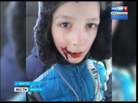 В Братске домашняя собака напала на семилетнего мальчика Из за травмы лица он оказался в больнице