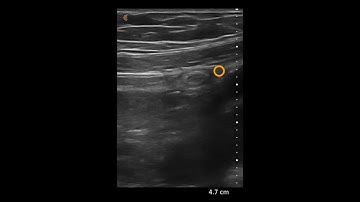 Appendicitis – Ultrasound Image Interpretation