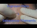 Ingrown Hairs and Sebaceous Filaments