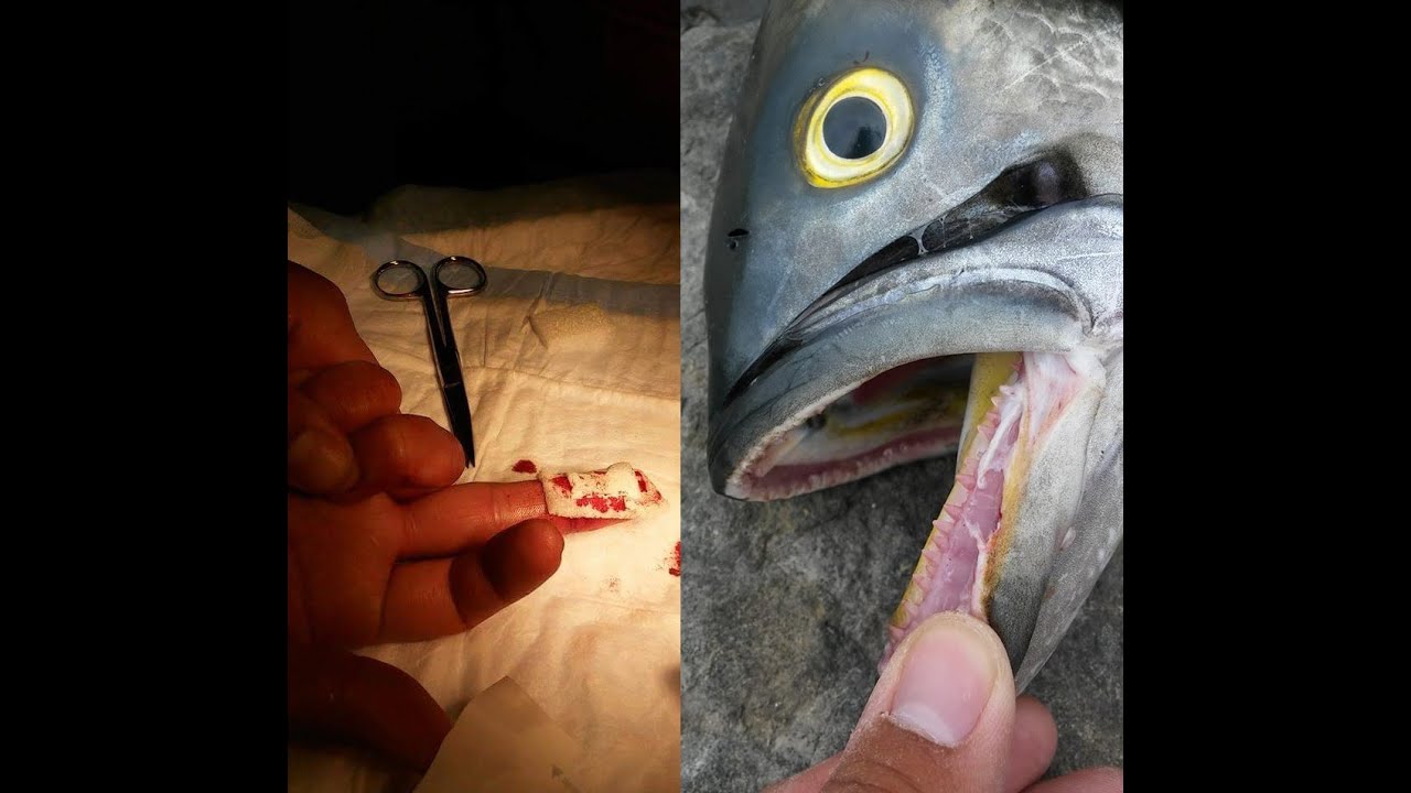 Gator Bluefish Bites Amateur Angler's Fingertip Off (TTYDSWYSAH