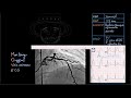Athérosclérose - Docteur Synapse