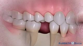 What is a Dental Implant