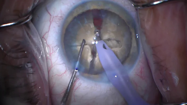 vertical chop in dense lens