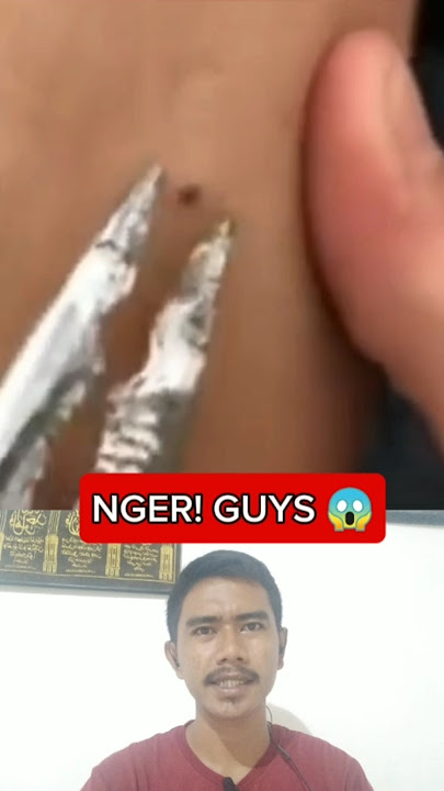 CABUT DURI DI DALAM DAGING MENGGUNAKAN TANG #shorts #feedshorts #splinter #trending #popular #fyp