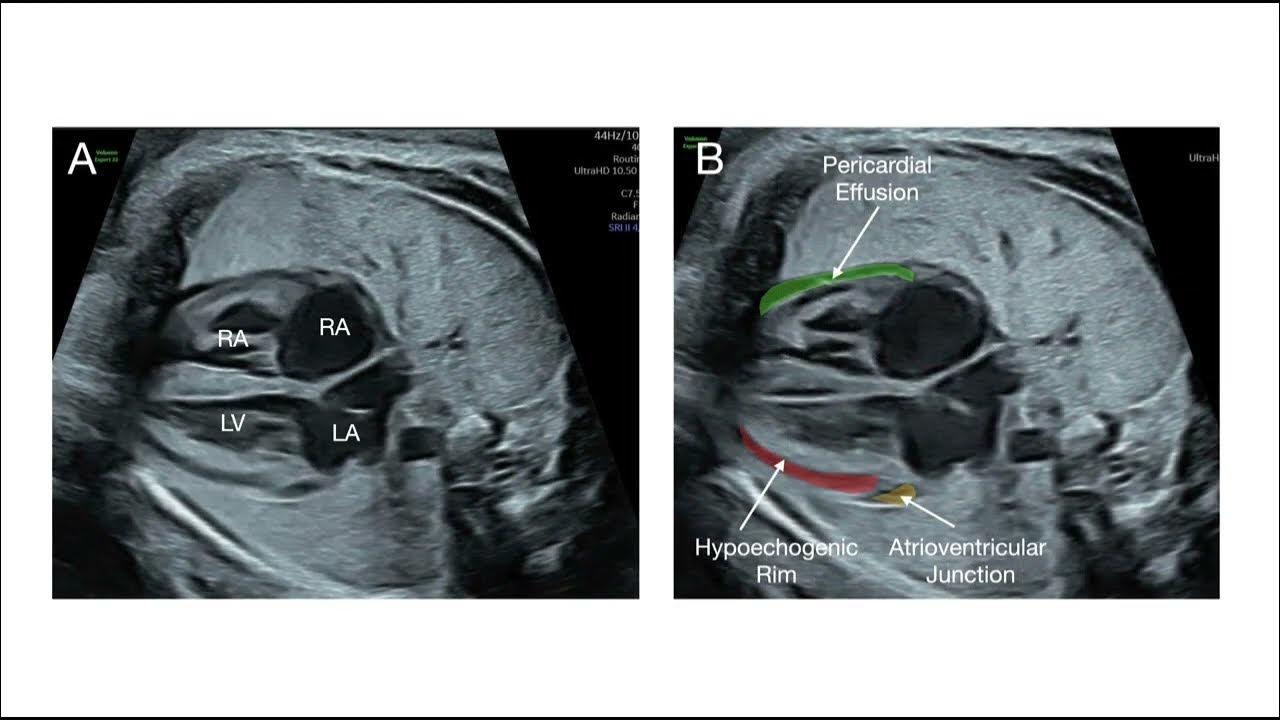 Enhancement Of Fetal Cardiac Screening As Proposed By The ISUOG enhancement-of-fetal-cardiac-screening-as-proposed-by-the-isuog