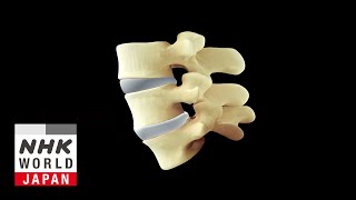 Treating Lumbar Disc Hernias With a Single Shot  Medical Frontiers