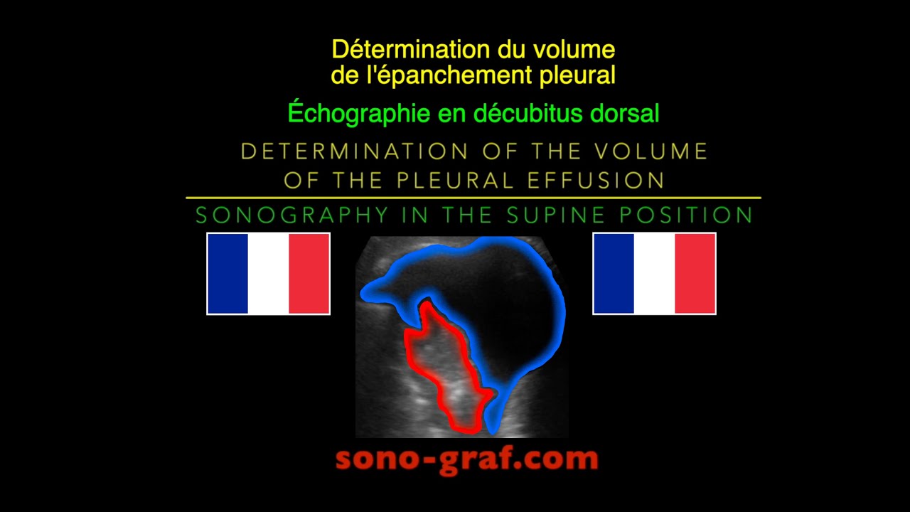 Échographie - Détermination du volume de l'épanchement pleural en ...
