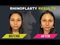 🔥 I Can’t Believe This is Me! | Rhinoplasty Transformation