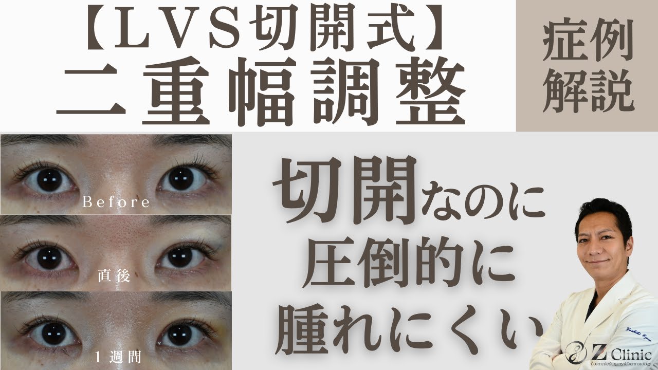 Case Commentary] Double Eyelid Surgery: Is There Such an Incision