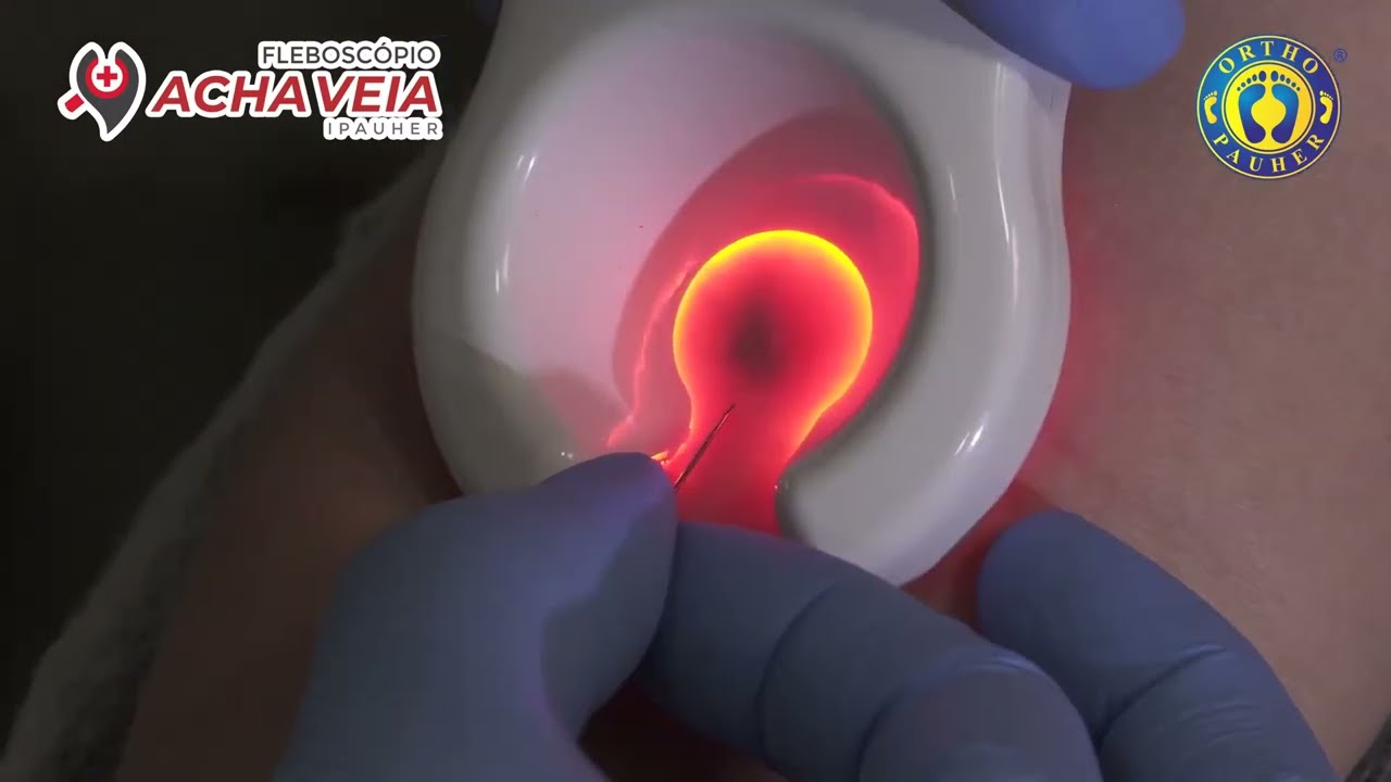 Venoscópio Localizador Acha Veia Fleboscópio Profissional - Ortho Pauher