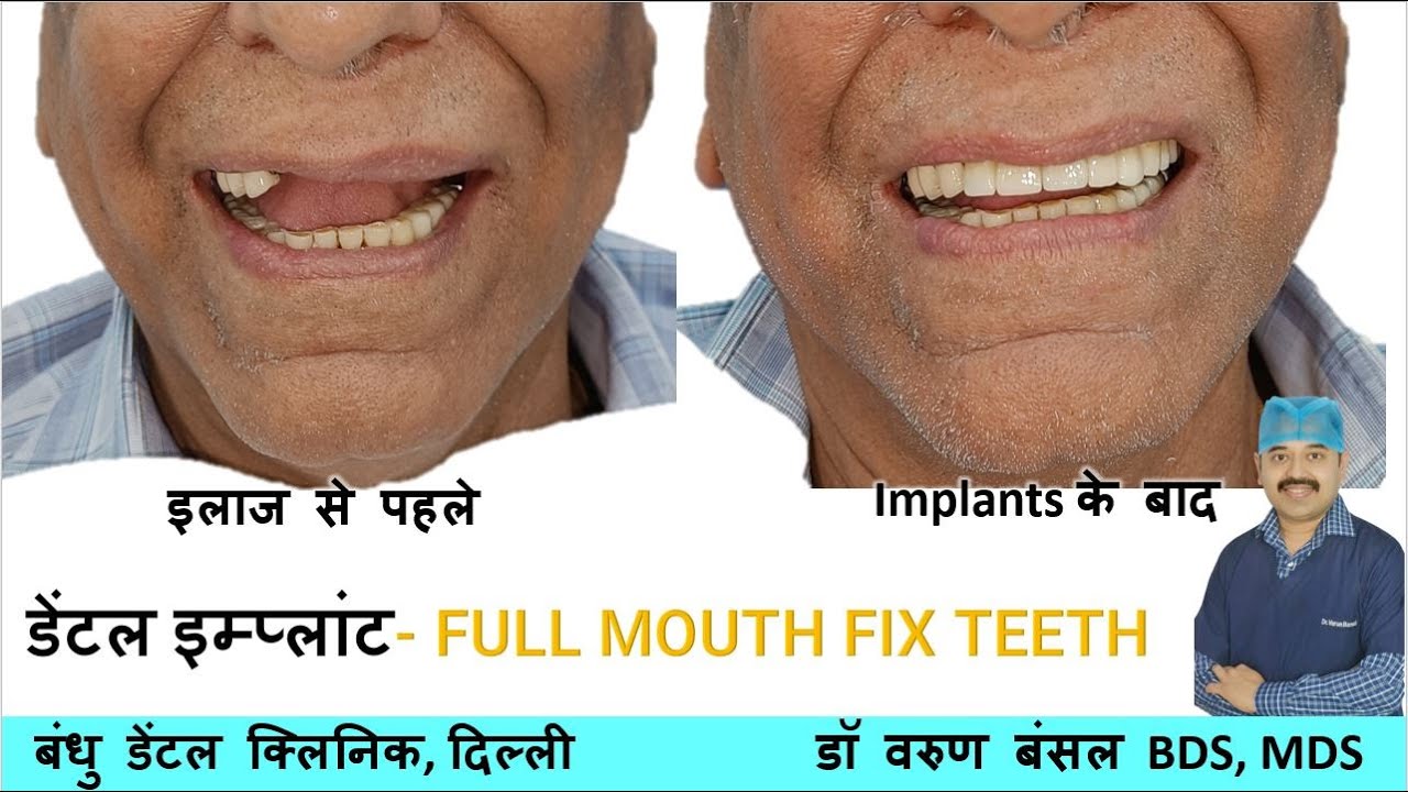 FULL MOUTH IMPLANTS FIX ZIRCONIA CROWNS YouTube