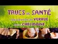 Trucs de sant 6  faire disparaitre une verrue avec la chlidoine  sophie lacoste