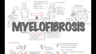 Primary Myelofibrosis - Overview (presentation, pathophysiology, investigation, treatment)