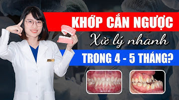 Niềng Răng Khớp Cắn Ngược - Xử Lý Nhanh Trong 4-5 Tháng Có Được Không | Nam Bùi Vinalign