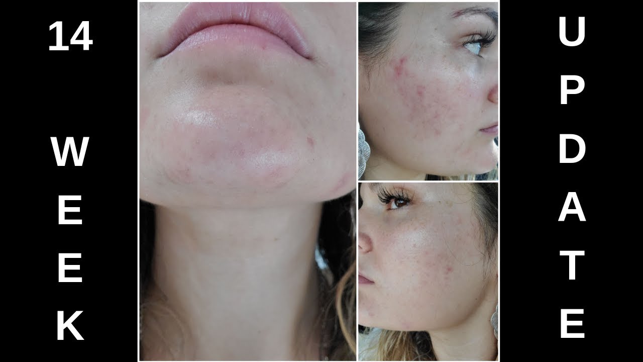 Spironolactone for Acne! 14 WEEK UPDATE! (+ Altreno update!) Episode