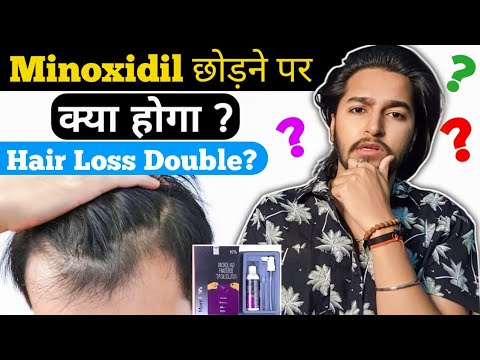 Minoxidil Hair Loss Double ? | What Happens When You Stop Minoxidil ...