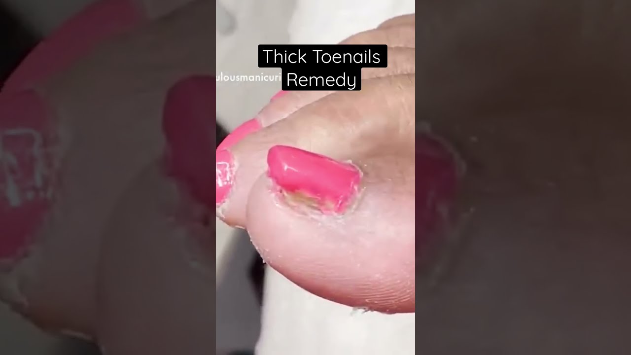Thick Toenails Remedy Let Me Show You How To Restore Your Nails Dremel Electricfile