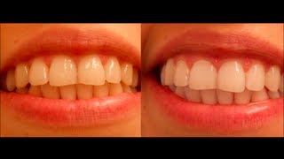 Как отбеливать зубы активированным углем?