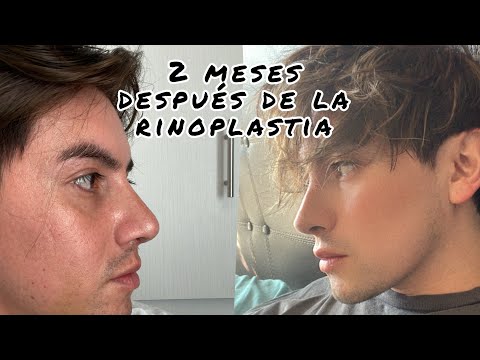 Así cambió mi nariz a 2 meses de rinoplastia | Damian Cervantes