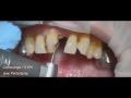 Anterior esthetic  crown Distribué par DentalPAG