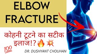 कोहनी टूटने का सटीक इलाज🔥Elbow Fracture Treatment 💥