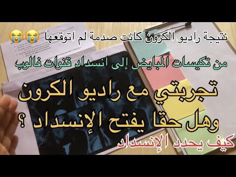تجربتي مع راديو الكرون والنتيجة غير المتوقعة  تكلفته وهل هو مؤلم