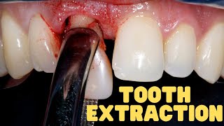 Tooth Extraction Explained | Wisdom Teeth Extraction Aftercare