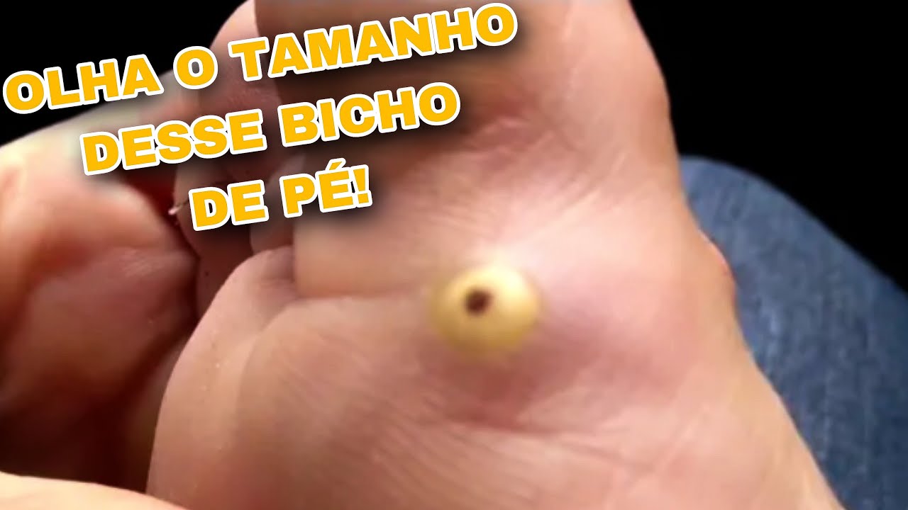 TIRANDO BICHO DE PÉ 😷!!! YouTube TIRANDO BICHO DE PÉ 😷!!! YouTube