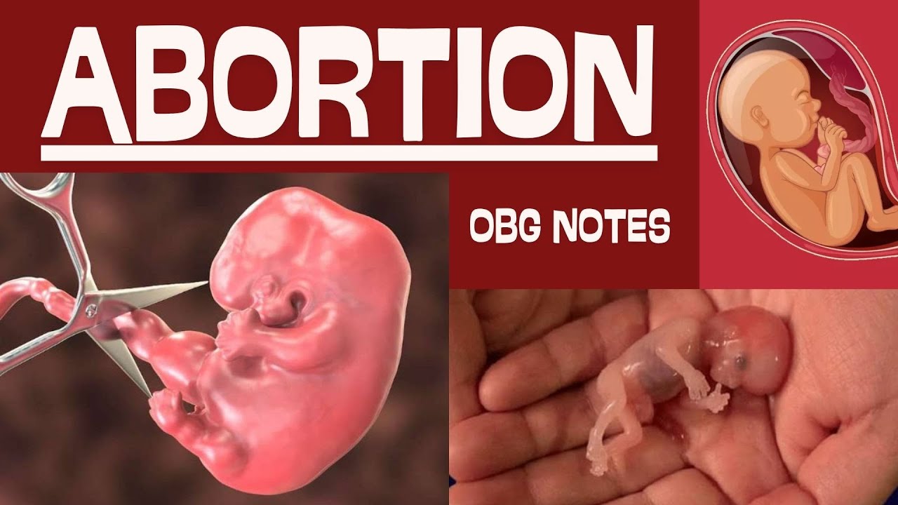 ABORTION | Types | Clinical features | Management Explained!!! High ...