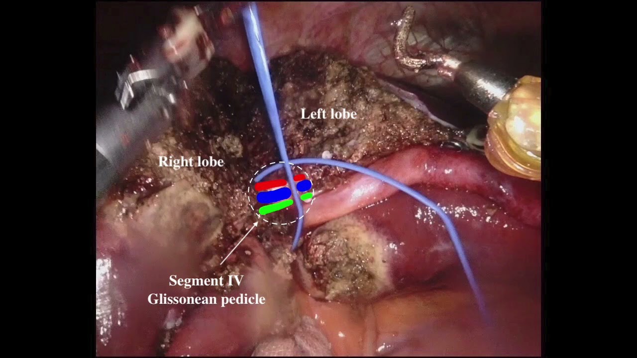 ROBOTIC CENTRAL HEPATECTOMY FOR HEPATOCARCINOMA BY GLISSONEAN APPROACH