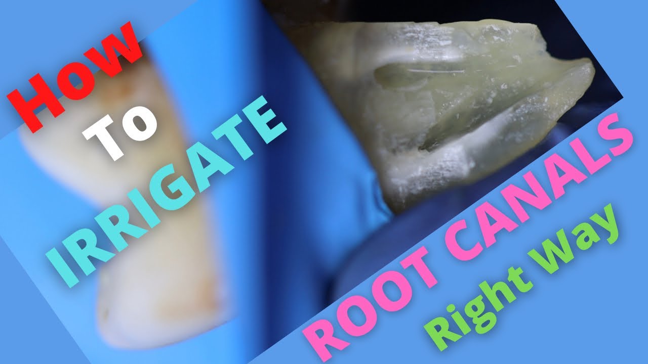 How To Irrigate Root Canals in Right Way | 