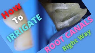 How To Irrigate Root Canals in Right Way | #shorts
