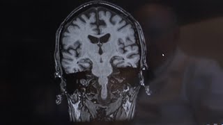 New study finds higher lifetime risk of eventually developing dementia