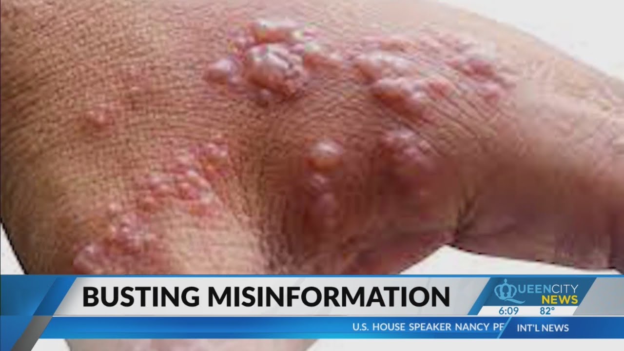 Local health working to combat monkeypox misinformation
