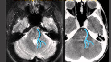 Developmental Venous Anomaly ("Venous Angioma") - a Vascular Malformation