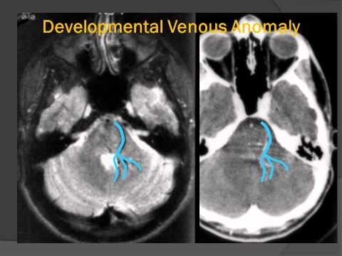 Developmental Venous Anomaly ("Venous Angioma") - a Vascular Malformation