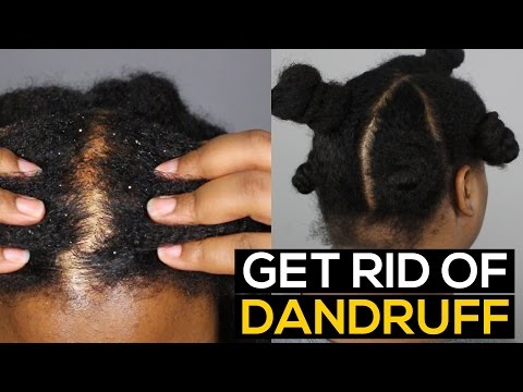 How To Get Rid van roos PERMANENT & FAST | Ammina Rose