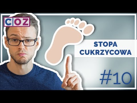 Wideo: Stopa Końsko-szpotawa U Dzieci - Leczenie, Masaż, Objawy Wrodzonej Stopy Końsko-szpotawej