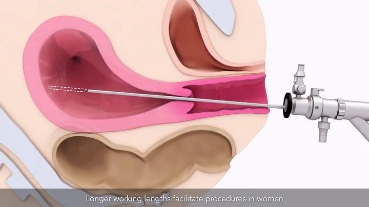 Basics of hysteroscopy | TVASurg - DayDayNews