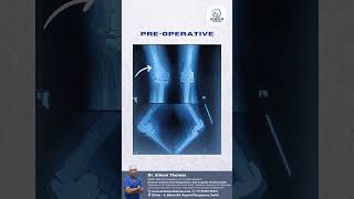 Implant Surgery Myths Debunked by Dr. Simon Thomas | Orthopaedic Insights