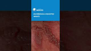 Verrugas Genitales Señal De Vph