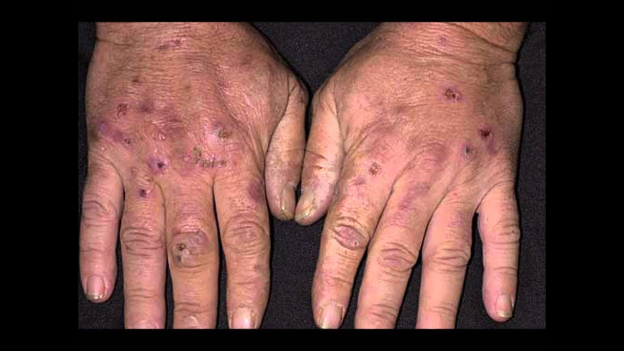 Porphyria Cutanea Tarda Useful Details Youtube