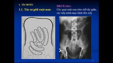 1 CHẨN ĐOÁN HÌNH ẢNH CẤP CỨU BỤNG