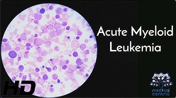 Acute Myeloid Leukaemia: Everything You Need To Know