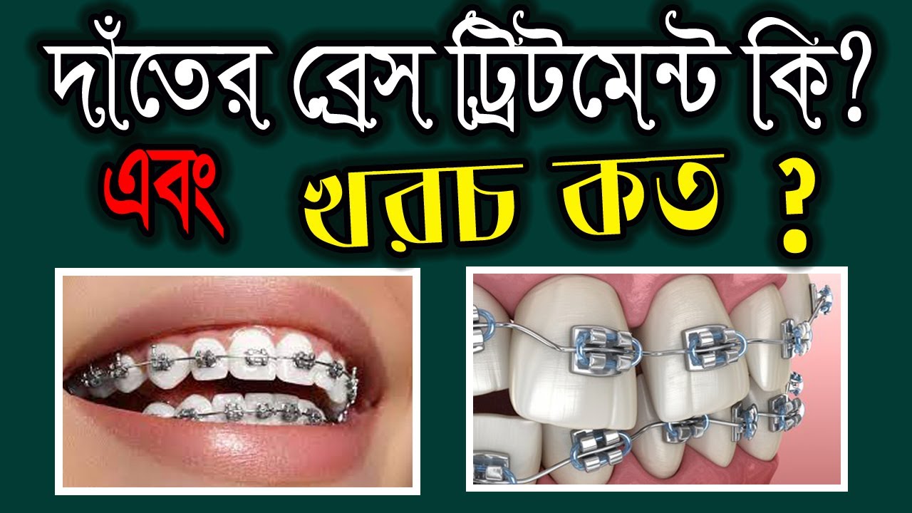 দাঁতে ব্রেস পড়ানোর খরচ কত টাকা Orthodontics braces treatment cost