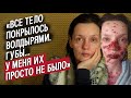 У меня язвы по всему телу: Алина | Вопреки