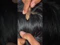 #fypviralシ #statisfying #lice #hair #LiceOnHead #liceremoval #brasil #xyzbcafyp #licecomb #kutu