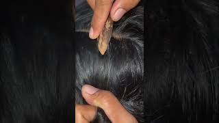 #fypviralシ #statisfying #lice #hair #LiceOnHead #liceremoval #brasil #xyzbcafyp #licecomb #kutu