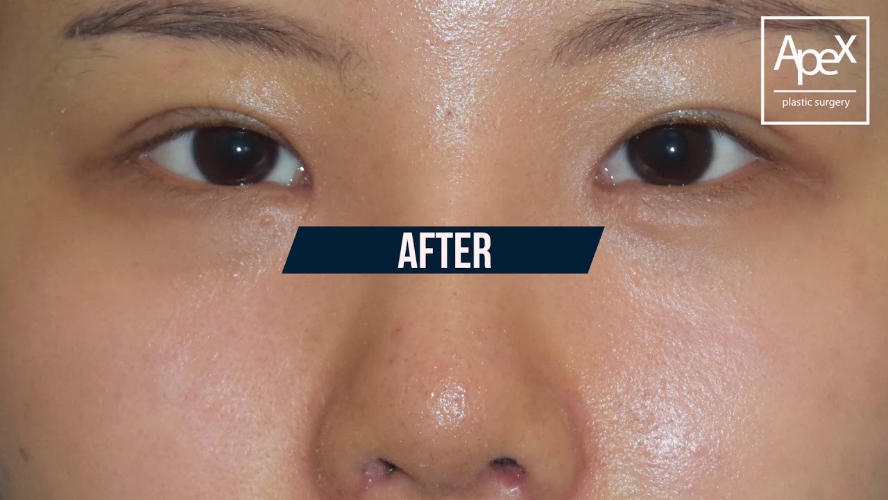 [Thẩm mỹ viện Apex] Đánh giá phẫu thuật thẩm mỹ viện Apex_Câu chuyện có thật (Nâng cơ mắt không rạch mổ, cắt mí mắt, thu nhỏ cánh mũi và nâng sống mũi, nâng mũi bằng cân cơ sau tai)